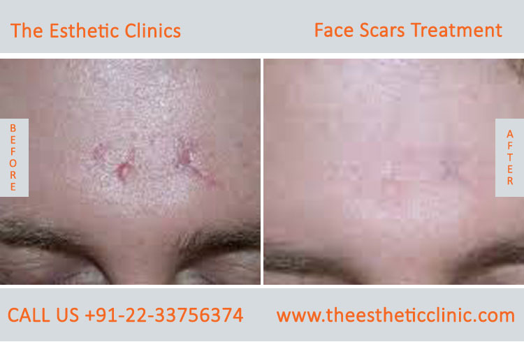 Face Scar Removal Laser Treatment before after photos in mumbai india (2)